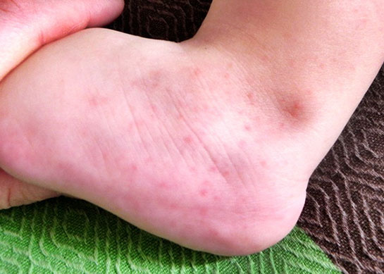 Ayakta Kirmizi Lekeler Neden Olur Hastalik Belirtisi Mi Saglik Haberleri Ayakta Kirmizi Lekeler Neden Olur Hastalik Belirtisi Mi Saglik Haberleri