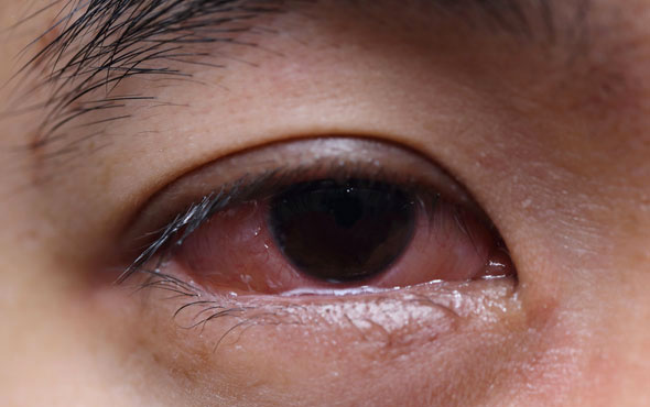 goz kasintisinin sebebleri nelerdir tedavisi icin ne yapilmali saglik haberleri