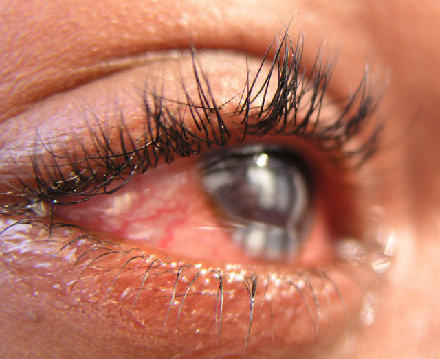 Goz Hastaliklarinda Dogru Sanilan Cok Onemli Yanlislar Saglik Haberleri Goz Hastaliklarinda Dogru Sanilan Cok Onemli Yanlislar Saglik Haberleri