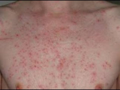 Vucutta Lekeler Neden Olur Kirmizi Leke Neyin Belirtisi Saglik Haberleri