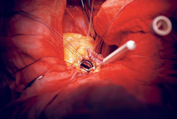 Kalp Kapakcigi Hastaliklari Belirtileri Yoruluyorsaniz Ve Saglik Haberleri