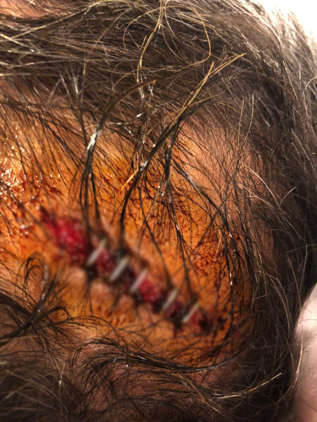 şenol güneş kafasındaki yara