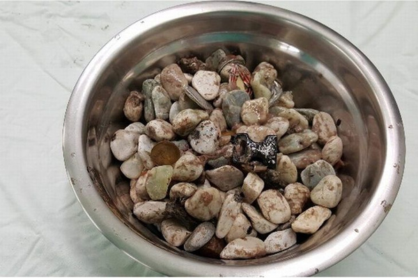 Midesinden çıkanı duyunca şoke olacaksınız! Tam 2 kilo - Sayfa 4