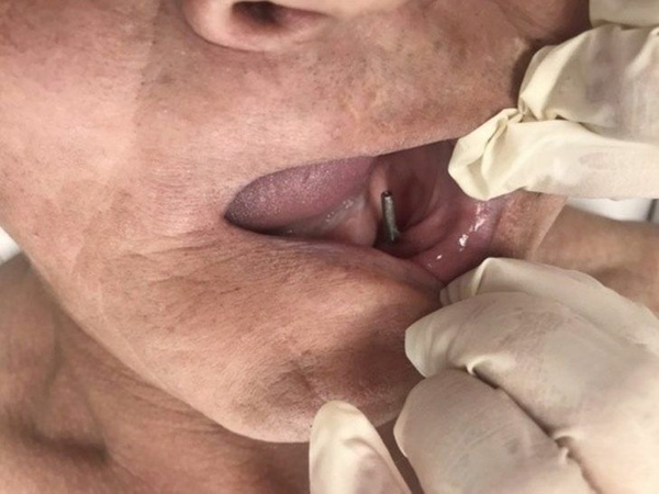 İmplant yerine sanayi tipi vida takmışlar! 28 yıl sonra öğrendi - Sayfa 2