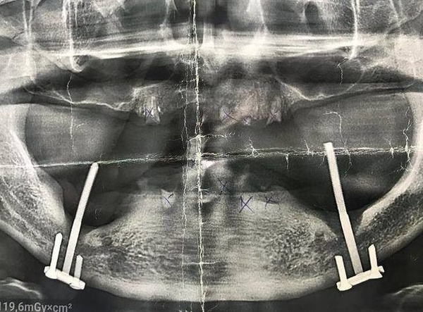 İmplant yerine sanayi tipi vida takmışlar! 28 yıl sonra öğrendi - Sayfa 4