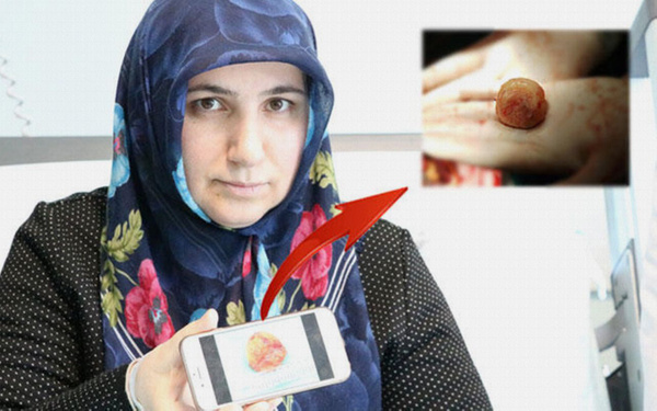 Kalbinden 6 santimetre çapında kitle çıkarıldı - Sayfa 1