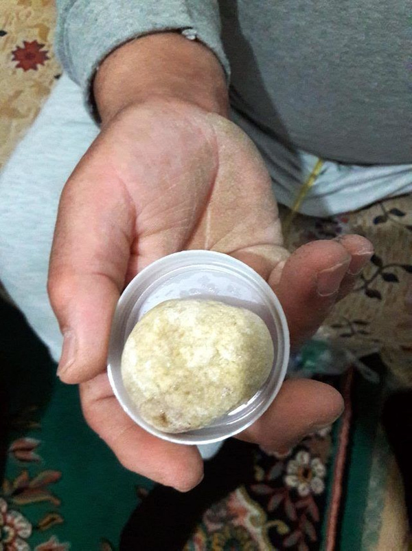 Mesanesinden çıkan doktorları bile şoke etti! Tam 300 gr ve... - Sayfa 3