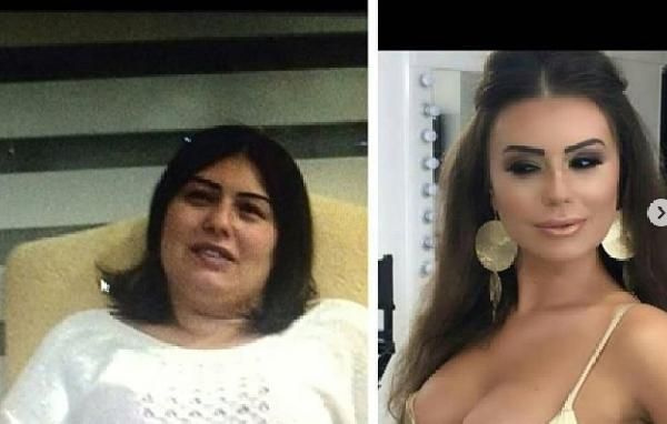 22'nci kez estetik ameliyatı oldu kadınlara mesaj yolladı - Sayfa 3