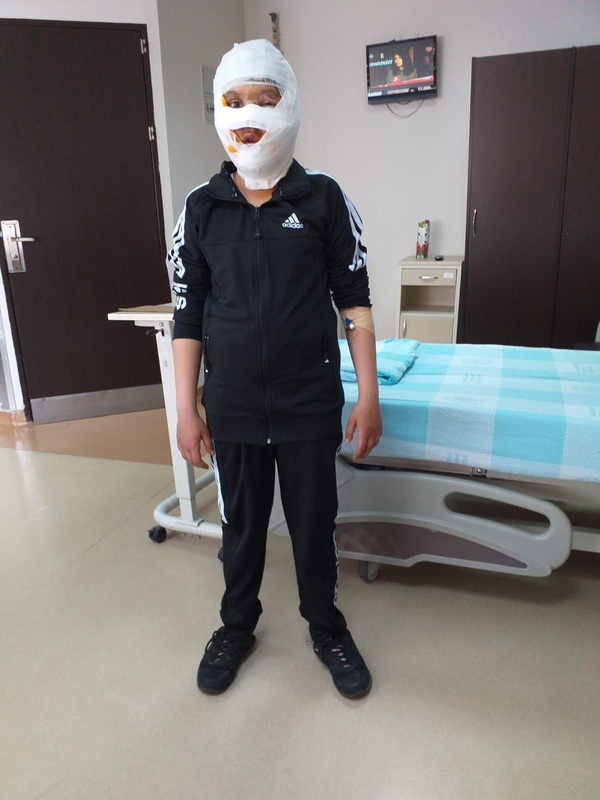 Sprey boya kutusu yüzünde patlamıştı işte 11 yaşındaki çocuğun son hali - Sayfa 1