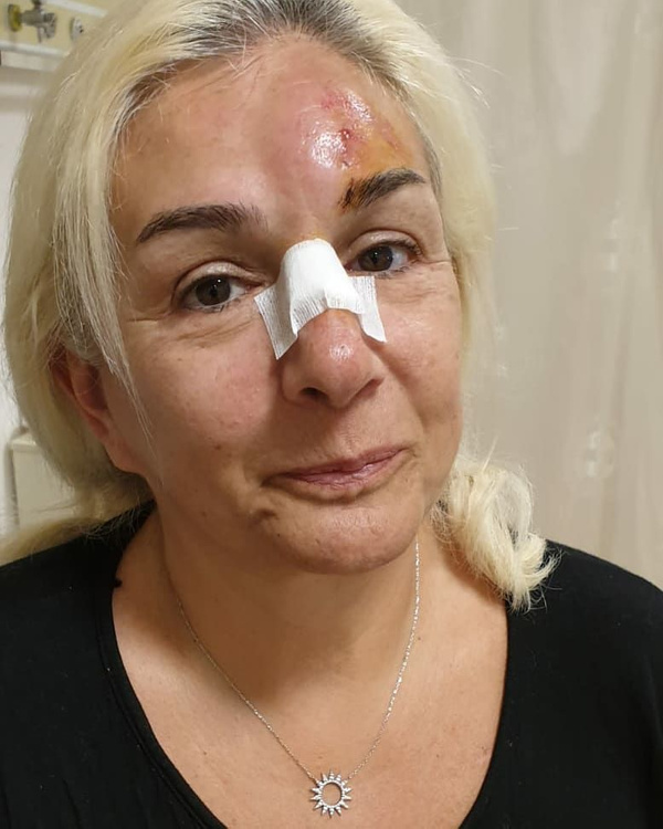 Burçin Orhon tanınmaz hale geldi Süheyl Uygur'un eşinin son görüntüsü korkunç - Sayfa 2