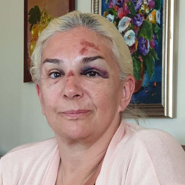 Burçin Orhon tanınmaz hale geldi Süheyl Uygur'un eşinin son görüntüsü korkunç - Sayfa 3