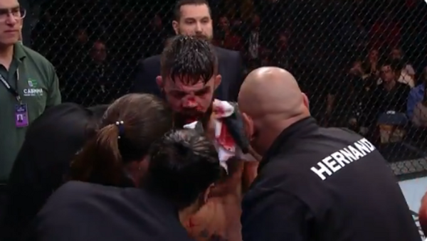 Mike Perry'nin burnu kırıldı suratı tanınmaz hale geldi - Sayfa 4