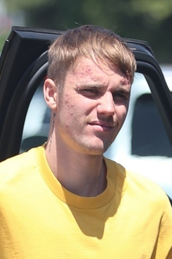 Depresyon tedavisi gören Justin Bieber'ın son hali herkesi korkuttu! Yüzü fena - Sayfa 4