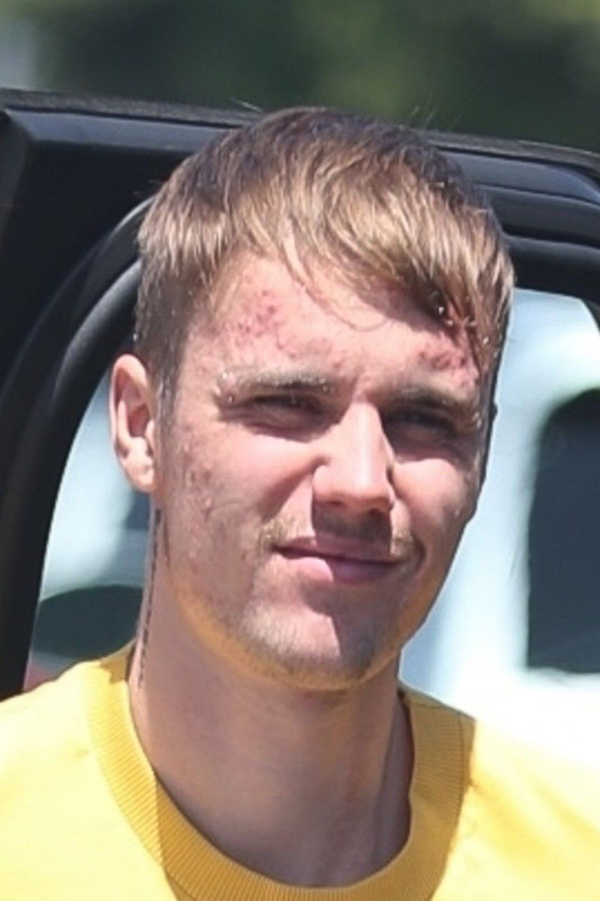 Depresyon tedavisi gören Justin Bieber'ın son hali herkesi korkuttu! Yüzü fena - Sayfa 5