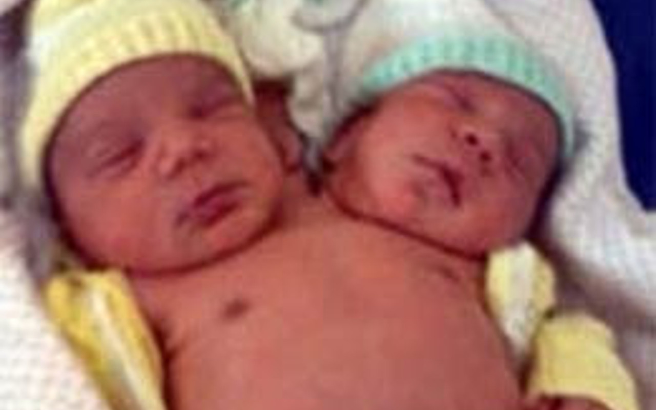 Çift başlı bebek herkesi şaşırttı Haber