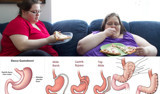 T&uuml;p mide gastrik bypass ve kelep&ccedil;e ameliyatı nedir hangisi iyi?