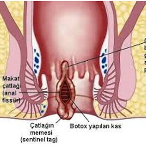 anal fissur makatta catlak ve fistul