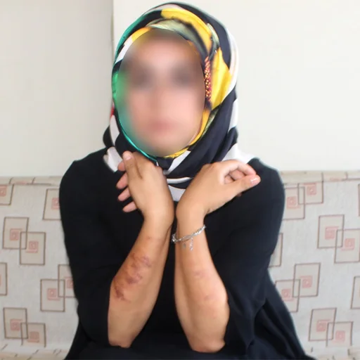 Lazer Epilasyon Yaptiran Kadin Yandi Adiyaman Da Guzellik Kazasi Saglik Haberleri