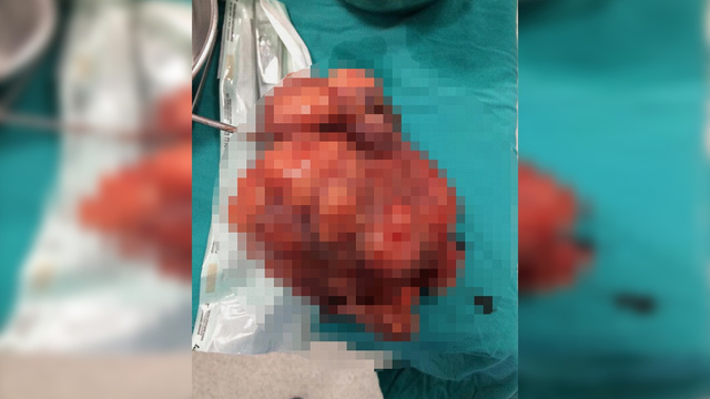 Manisa'da bir kadının karnından 2 kilogram ur çıktı