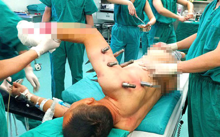 Çin'de işçinin vücuduna demir çubuklar saplandı