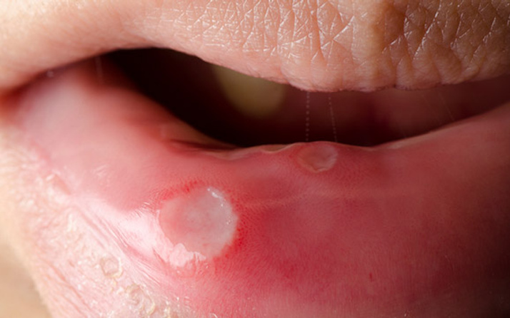 Aft bulaşıcı mı ağız yarası aft hangi vitamin eksikliğinde olur? 