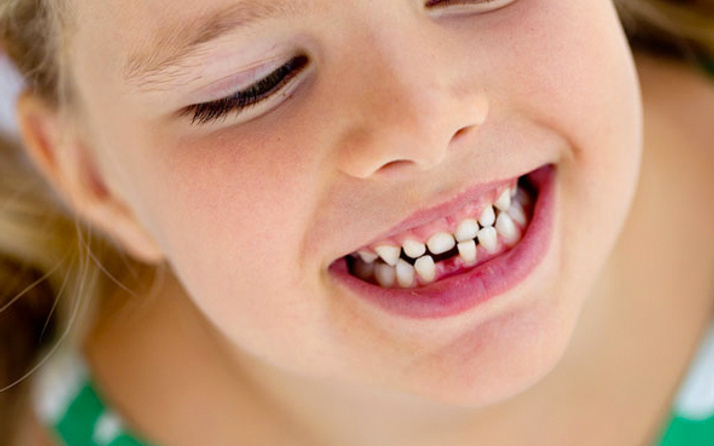 Diş çürüklerini tedavi etmek için lazer uygulaması faydalı olur mu?