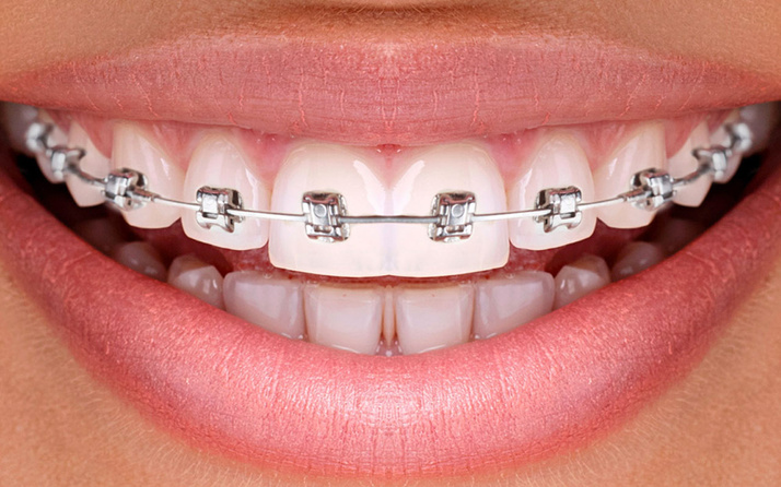 Diş telinin dudaklara bir zararı var mıdır?