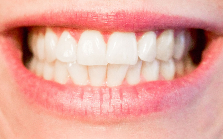 Bleaching nedir diş beyazlatmak için bleaching faydalı mıdır?