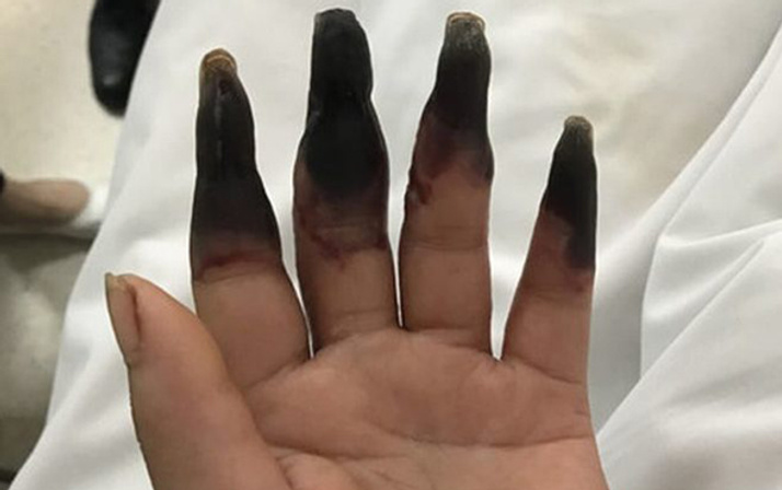 Parmakları biranda karardı sebebini duyunca şoke olacaksınız