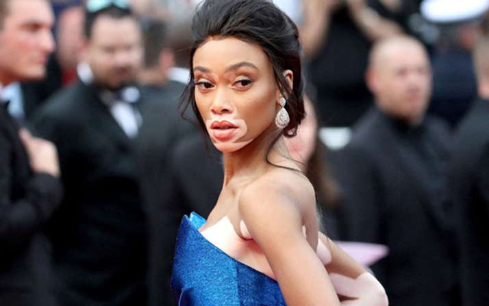 Sıradışı görüntüsüyle dikkat çekmişti! Winnie Harlow artık bir melek