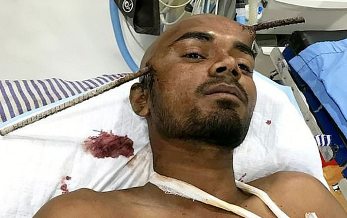 İşçinin başına demir saplandı! Doktorlar onu sağ görünce şaşırdı