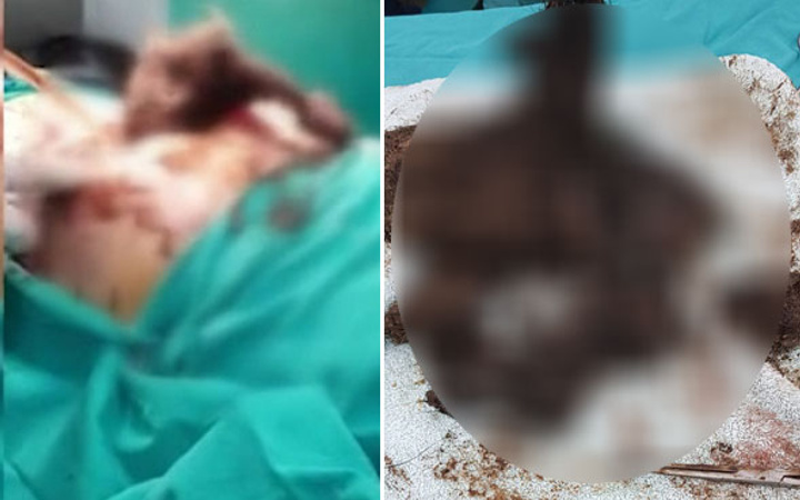 Ameliyatı yapan doktor şoke oldu! Midesinden çıkana bakın