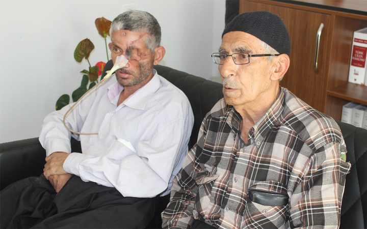 Ağrıyan dişini çektirdi yüzünün yarısı çöktü bir gözü kayboldu