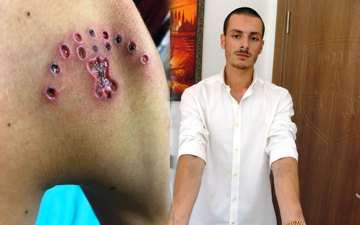 Bodrum'da asker olmak için dövmelerini sildiren genç hayatının şokunu yaşadı