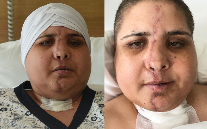 Trafik kazasında yüzü ikiye ayrıldı! 10 saatlik ameliyatla tekrar brleştirildi