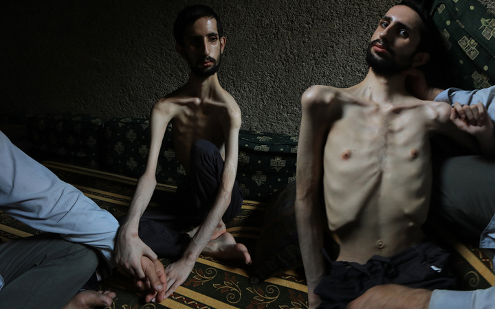18 yaşındaki Abdullah'ın hali yürekleri burktu! 35 kiloya düştü günden güne eriyor