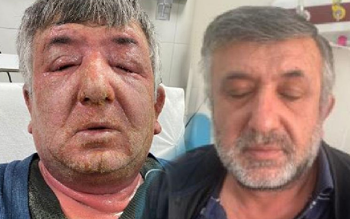 Ankara'da hayatının hatasını yaptı gözleri kapandı! Öldürecek gibi kaşıntı