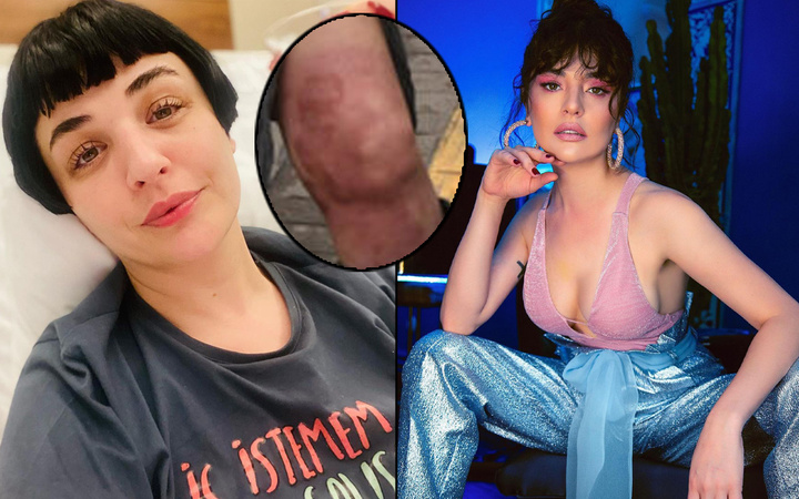 Mor renge dönüştü! 35 gün hastanede yattı Gonca Vuslateri 10 operasyon geçirdi