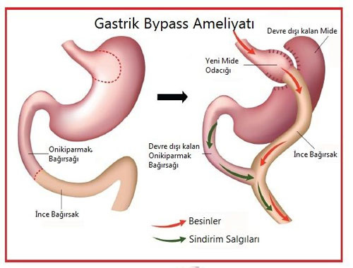 Gastrik bypass ameliyatı nedir?