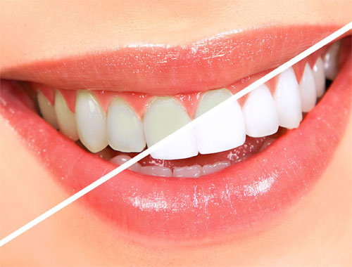 Diş beyazlatma nedir ve nasıl yapılır?