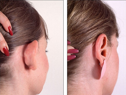 Kepçe kulak ameliyatı nedir nasıl yapılır?