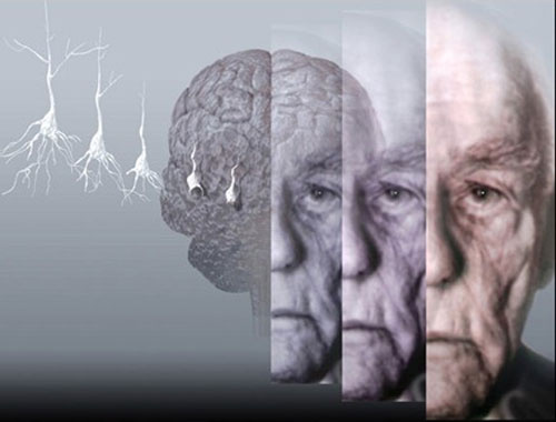 Bunama 'Alzheimer' hastalığı