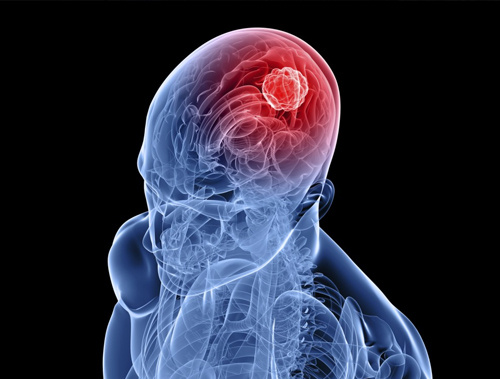 Beyin tümörü belirtileri nedir tanısı nasıl konur?