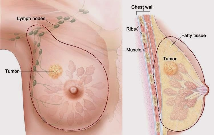 Meme kanseri belirtileri göğüs nasıl görünür?
