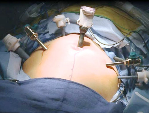 Mesane kanseri tedavisinde robotik cerrahi