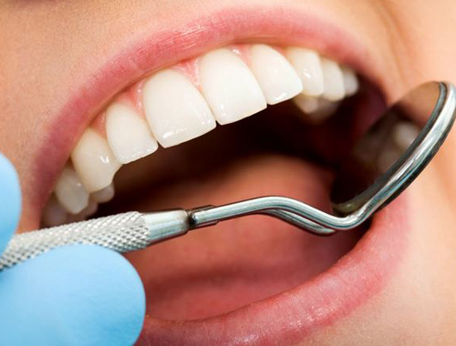 Lamina veneer nedir tedavisi dişlere nasıl uygulanır?