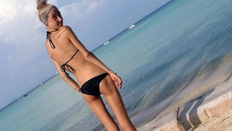 Anoreksiyadan kurtulan genç kızın mucizevi değişimi