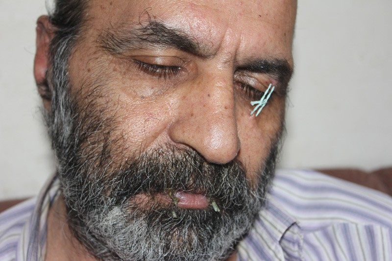 İranlı sığınmacı ağzını ve kulaklarından sonra şimdi de...