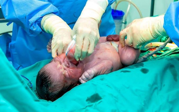 Bebek ağlayarak dünyaya geldi doktorlar gerçeği görünce şoke oldu