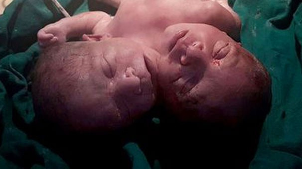 'Çift başlı bebek' akıllara durgunluk veren mucizeye bakın